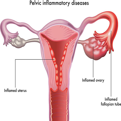 Pelvic Infection Treatment